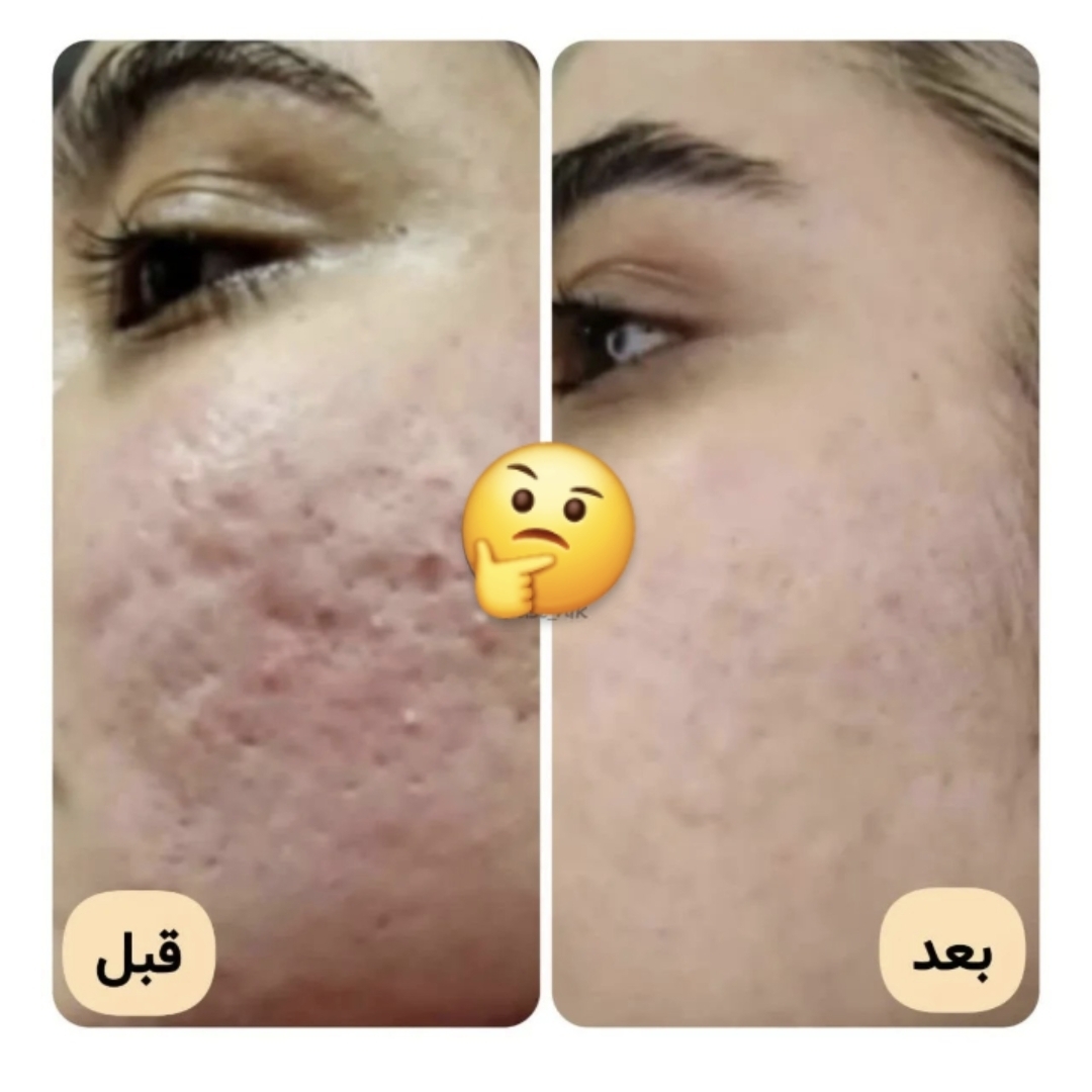 روتین پوست چرب با محصولات تراست | بهترین برنامه مراقبت از پوست چرب