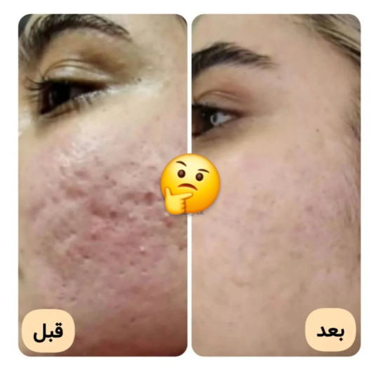 روتین پوست چرب با محصولات تراست | بهترین برنامه مراقبت از پوست چرب