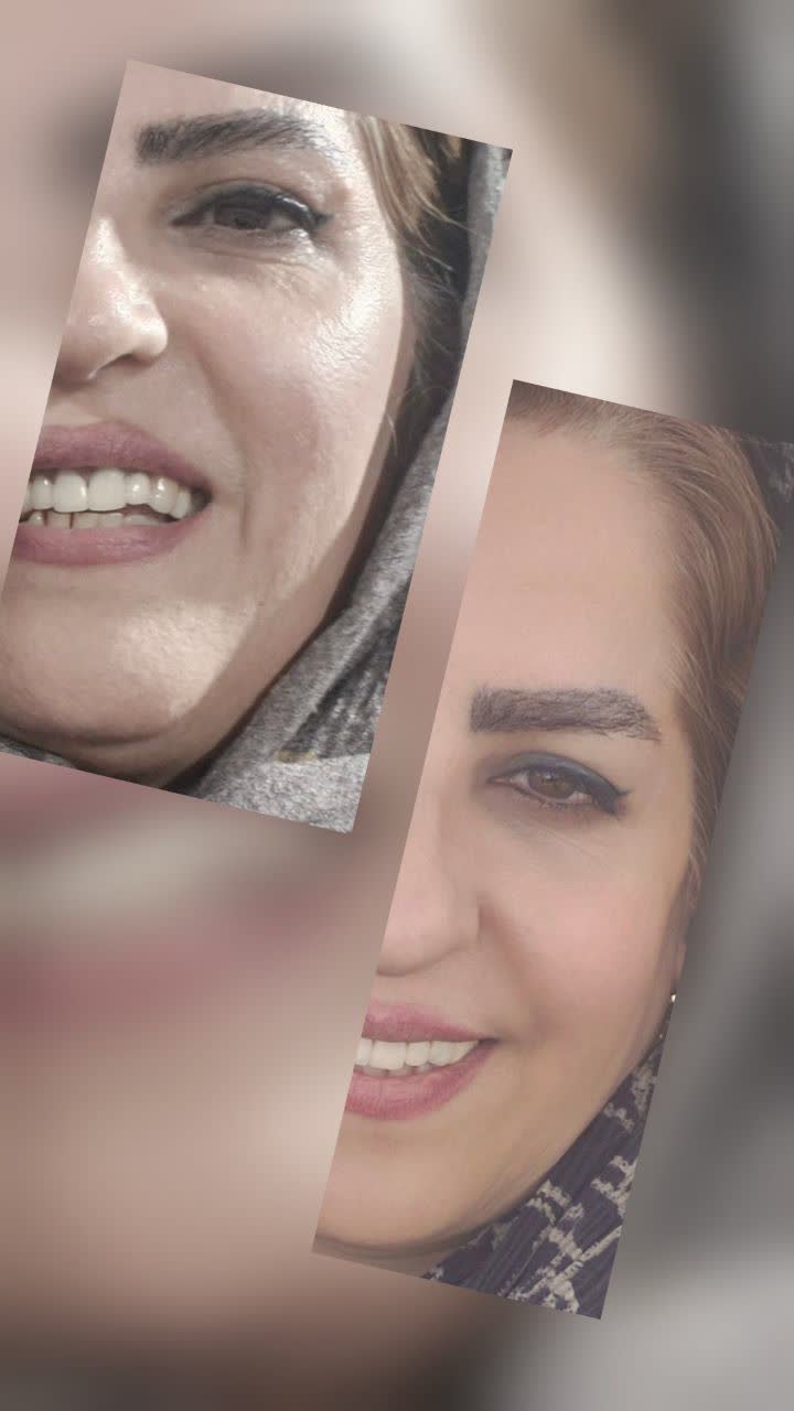 کدری پوست صورت؛ علت چیست و چگونه پوست کدر و خسته را شفاف کنیم؟