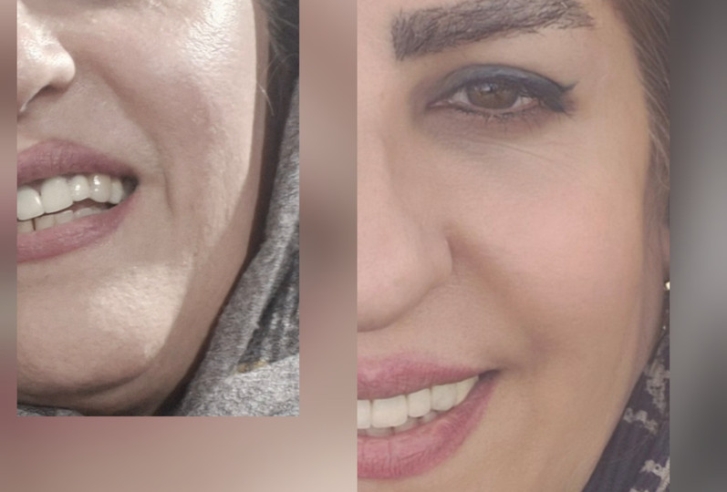 کدری پوست صورت؛ علت چیست و چگونه پوست کدر و خسته را شفاف کنیم؟